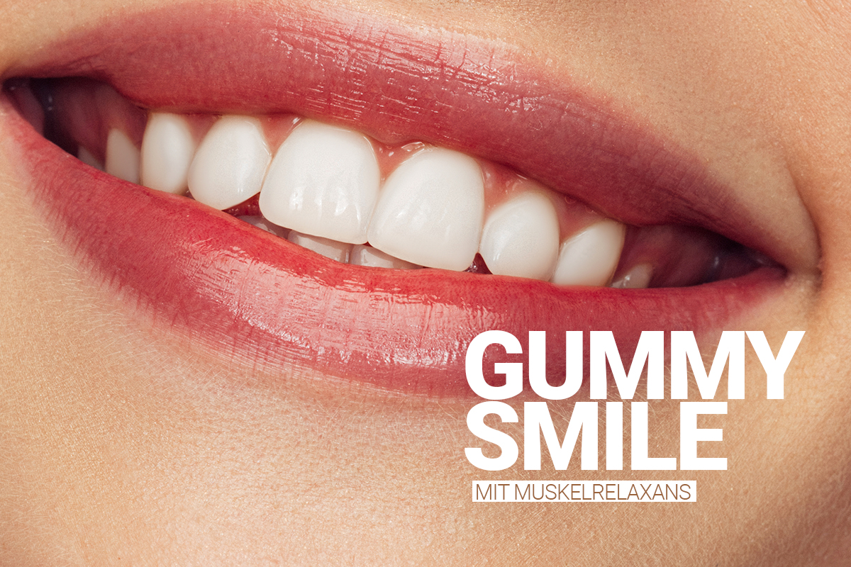 Behandlung des Gummy Smile mit Muskelrelaxans bei M1 Med Beauty Austria